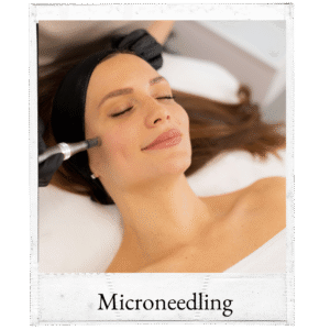 Microneedling
